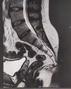 MRI of angulated coccyx