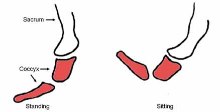hypermobile coccyx