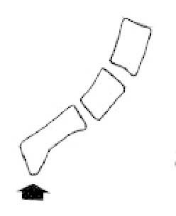spur on coccyx