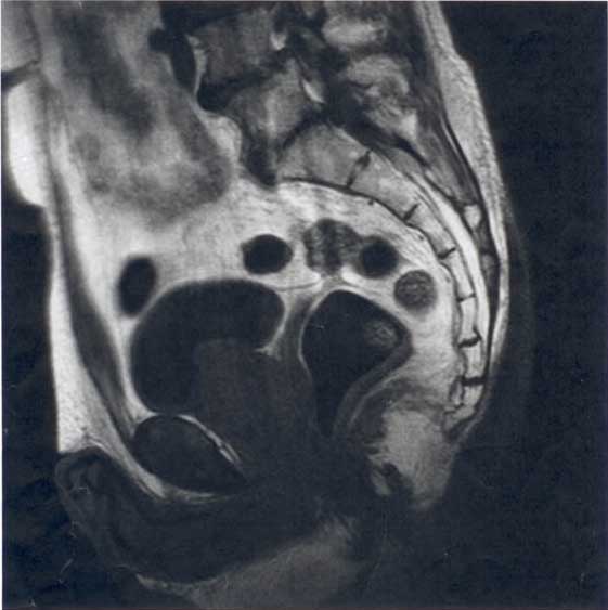 mri image including coccyx