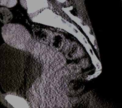 CT of my pelvis/abdomen