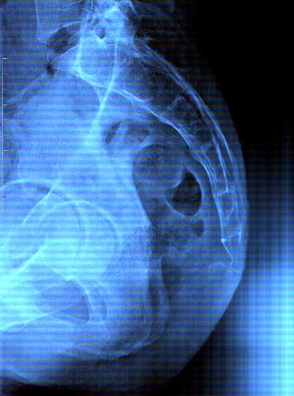 x-ray dislocated coccyx