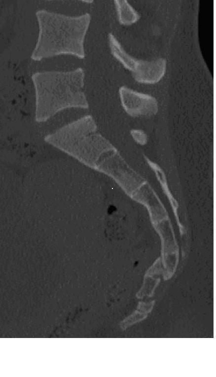 CT scan of broken sacrum and coccyx