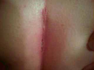 wound pulling open