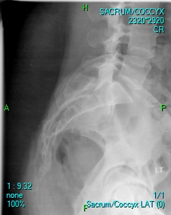 coccyx x-ray