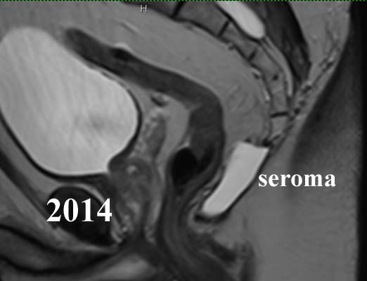 seroma