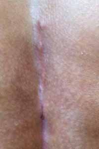 coccyx scar
