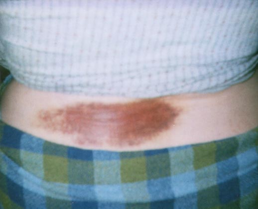 Stacie's bruise