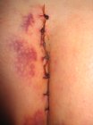 Carol's surgery 1