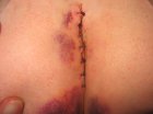 Carol's surgery 2